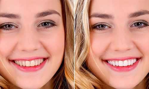 Teeth Whitening in Powai