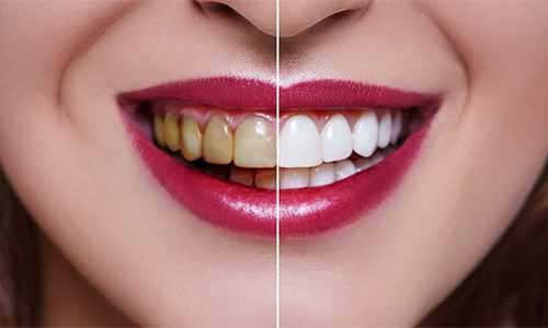 Teeth Whitening in Marol